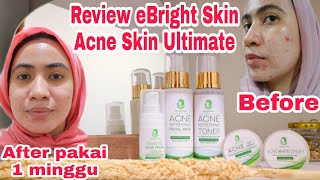 REVIEW EBRIGHTSKIN SKINCARE UNTUK KULIT BERJERAWAT