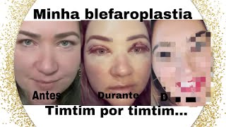 TODA VERDADE SOBRE A MINHA BLEFAROPLASTIA!           Antes, durante e depois.