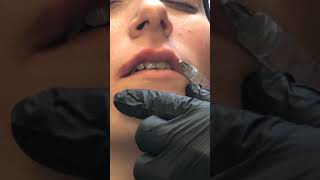 Lip Augmentation!