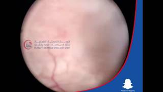 Double J Stent Removal by Cystoscopy DJ Dr. Ali Mehdi Zadeh Urologist in Kuwait