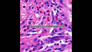 Histopathology of Urticaria Pigmentosa #shorts #dermpath #dermatopathology