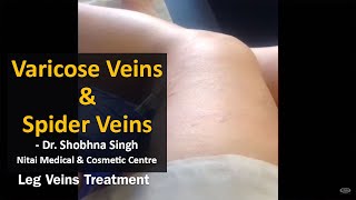 Treatment for Varicose Veins & Spider Veins |  Dr. Shobhna Singh | Nitai Cosmetics Melbourne