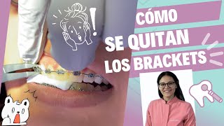 Así se quitan los brackets! 👀 #braces