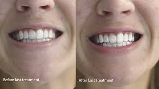 Lumineux Teeth Whitening Strips 21 Treatments Enamel Safe - Whitening Without The Sensitivity