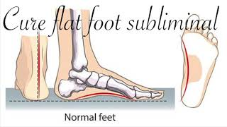 fix flat foot subliminal