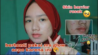 ALASAN AKU STOP MENGGUNAKAN MS GLOW ACNE SERIES ! (buat yg mau beli wajib tonton dulu)