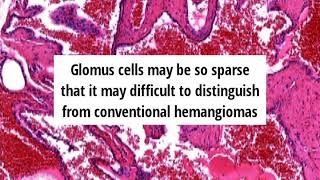 Pathology of Glomangioma by Dr Sampurna Roy MD