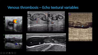 lower limb venous doppler