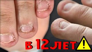 ЛИШИЛАСЬ НОГТЕЙ В 12 ЛЕТ?!😱 Наращивание РЕБЕНКУ.КАК ИСПРАВИТЬ НОГТЕВУЮ ПЛАСТИНУ?Преображение+ФИНАЛ