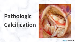 Metastatic vs Dystrophic Calcification | Pathology | High YIeld