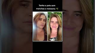 Sua pele merece esse cuidado e tratamento #melasma #cuidadoscomapele #dicas #beleza #skincare #pele