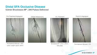 Dr. Nicolas Mouawad Teaser Clip: Shockwave M5+ for SFA Disease