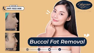 PIPI TIRUS INSTAN DENGAN BUCCAL FAT REMOVAL