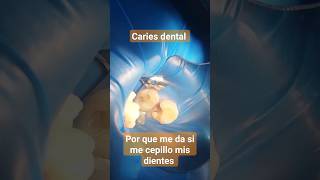 Por qué me da Caries dental si  cepillo mis dientes 🦷🪥#suscribete 😃