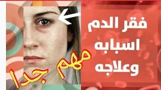 ماهو فقر الدم سببه ومشكل عدم امتصاص مادة الحديد مع ذكر الحلول الممكنة لتفادي الانيميا