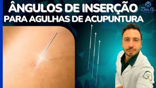 Aprenda Quais são os Diferentes Ângulos de Inserção de Agulha de Acupuntura e Como Usar Corretamente