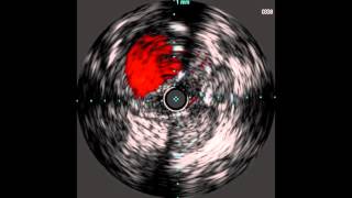 Pioneer IVUS Run   Case 3 Run 1