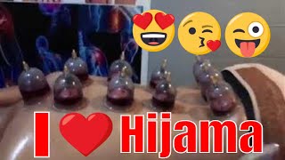 Prince ABDULMATEEN Bolkiah  try the Hijama Therapy Procedure