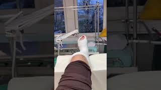 POV: You broke your leg - Short Leg Plaster Cast #shorts