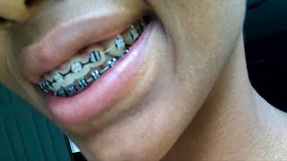 BRACES UPDATE + TIPS + BLACK RUBBER BANDS!