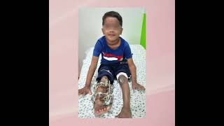 Our Successful Treatment on Chronic Infected Leg Bones