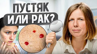 О чем КРИЧАТ красные родинки на теле? Люди зря недооценивают ЭТИ точки...