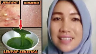 Ajaib! Cara Menghilangkan Jerawat dan Komedo Alami dan Ampuh Tanpa Obat!