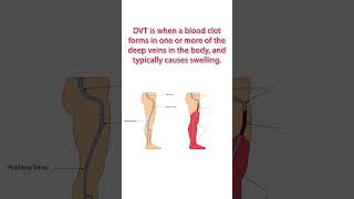 Watch Out for THESE Signs! #cardiovascularhealth #dvt #legpain