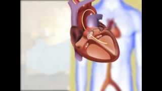 Heart Disease Procedures - Cardiac Catheterization