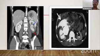 Lecture: Upper Urinary Tract Injury