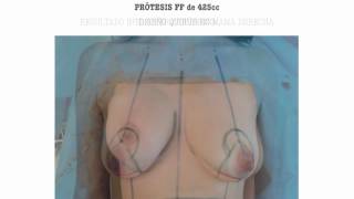 MASTOPEXIA CON PROTESIS