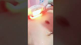 Body 2😱 hair laser