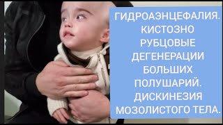 ГИДРОАЭНЦЕФАЛИЯ.ПОЛНОЕ ОТСУТСТВИЕ МОЗГА. КИСТОЗНО РУБЦОВЫЕ ДЕГЕНЕРАЦИИ БОЛЬШИХ ПОЛУШАРИЙ.