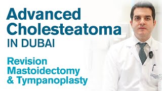 Advanced Cholesteatoma - Revision Mastoidectomy & Tympanoplasty - Dr. Michael Nehme