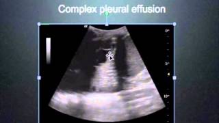 Ultrasound for Pulmonary TB