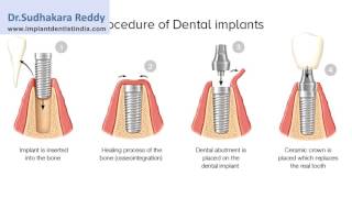 Tooth Replacement In Bangalore | Painless Dental Implants In India