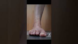 Antes x Depois: joanete grave com dedos sobrepostos #ortopedia #joanete #bunions #viral #fyp