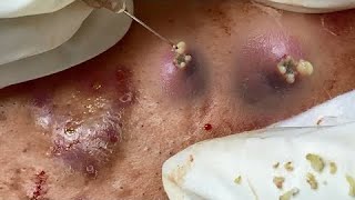 Big Cystic Acne Blackheads Extraction Blackheads & Milia, Whiteheads Removal Pimple Popping