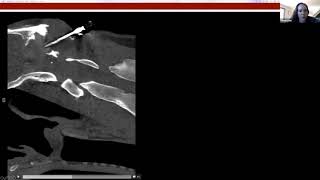 Osteomyelitis Case Study